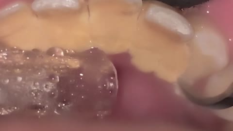 How dentists clean teeth