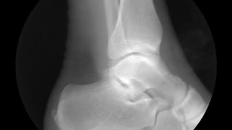 Foot Bones From X-ray View