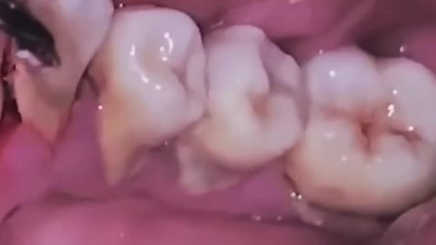 Scaling of teeth (II)