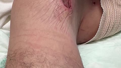 Knee Infection