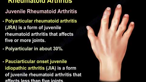 Arthritis Of The Fingers - Everything You Need To Know - Dr. Nabil Ebraheim (Cure Arthritis Naturally)