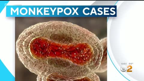United States now has most monkeypox cases in world; vaccine becoming more readily available
