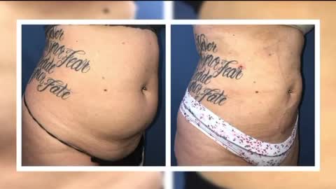 Dr. Thomas BARNES Abdomen Liposuction Results! Must see!