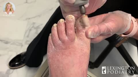 are you terrified by gross toenail then you need this