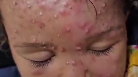Noura Nidal Al-Shawaf, a girl from Gaza, suffers from a virus spreading across her body