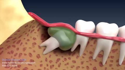 How Wisdom Teeth are Removed