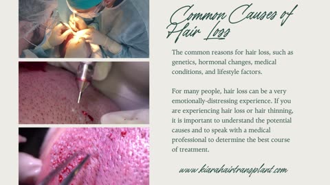 Hair transplant clinic in Chandigarh