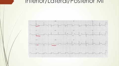 NSTEMI vs STEMI