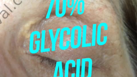 Xanthremovel with 70% Glycolic Acid cosmetic peel