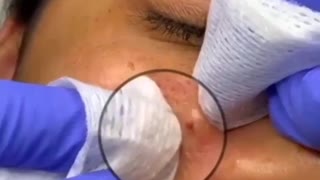 Pimple Cyst Soft Pops!!!