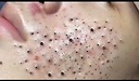 Blackheads