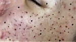 Blackheads and pimples removal