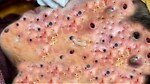 Squeeze blackheads | Acne And Pimples