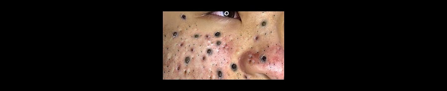 Squeeze blackheads | Acne And Pimples