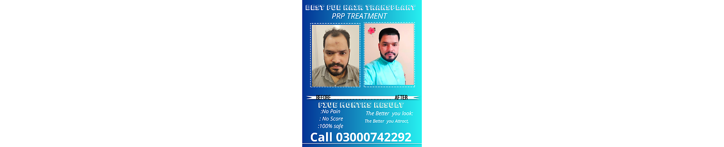 Best fue hair transplant