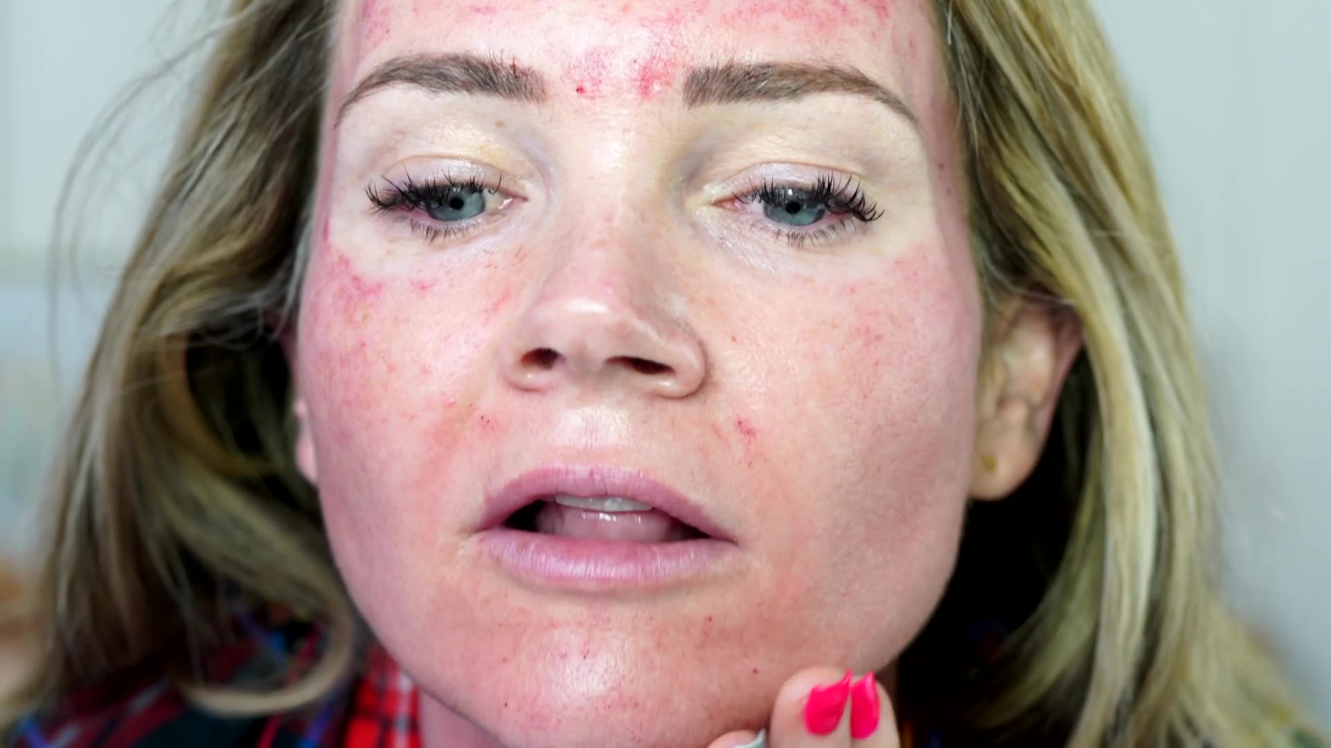ILLUMA Pen Microneedling w/ Celltermi Stem video