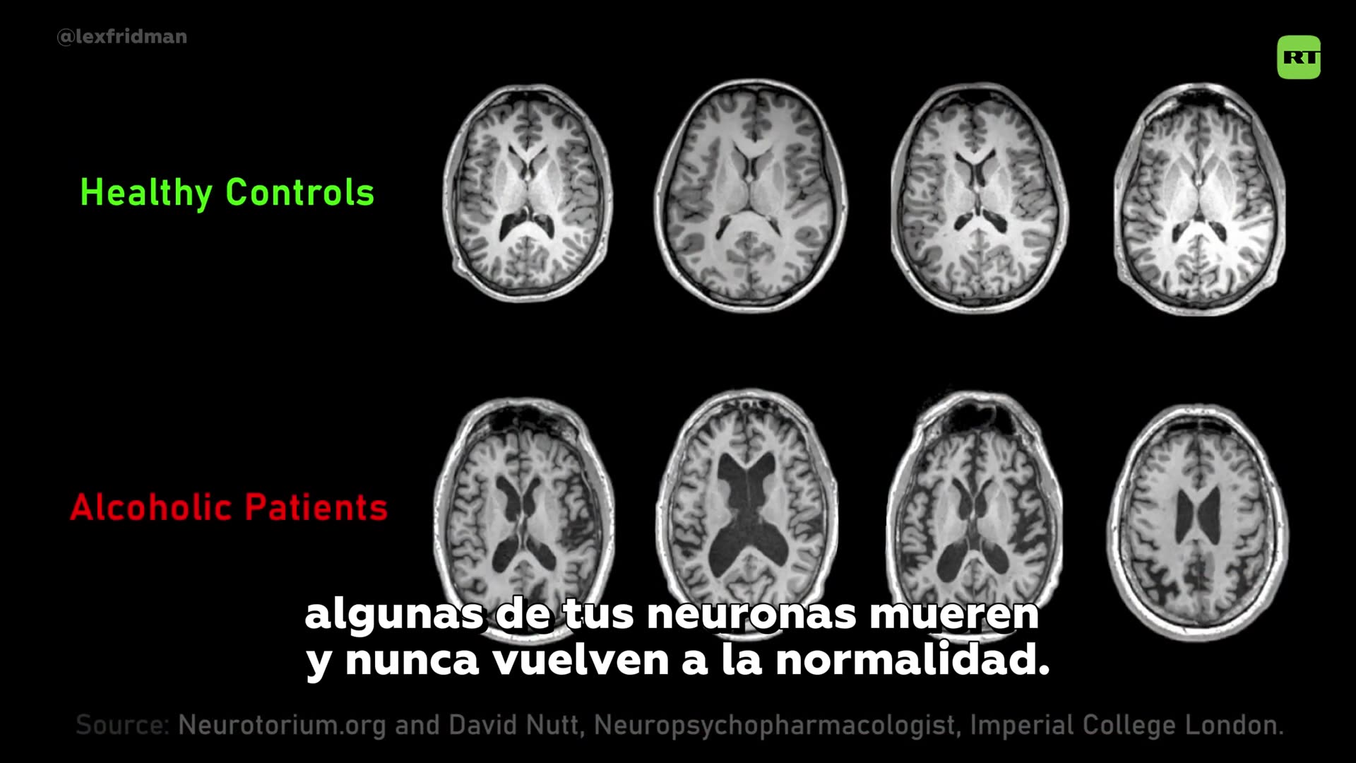 ⁉️¿El alcohol convierte en zombis a tus neuronas?