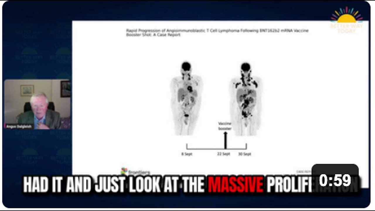 Oncology Professor Angus Dalgleish shows a peer-reviewed case report of a physician whose cancer [took] off in just a few days following a COVID BOOSTER.