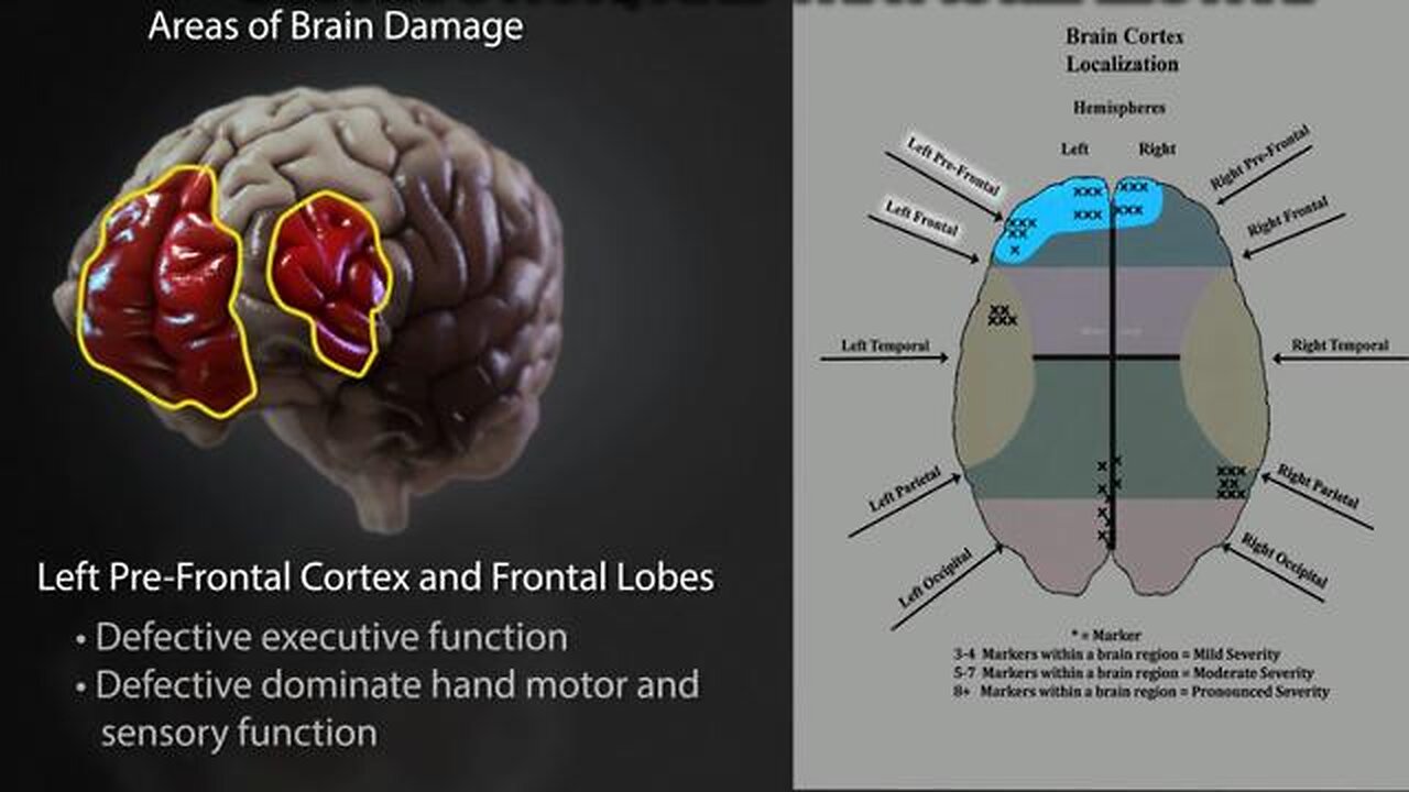 mRNA vaccines function as chemical lobotomies - SEVERE brain damage & DEVASTATING mental health