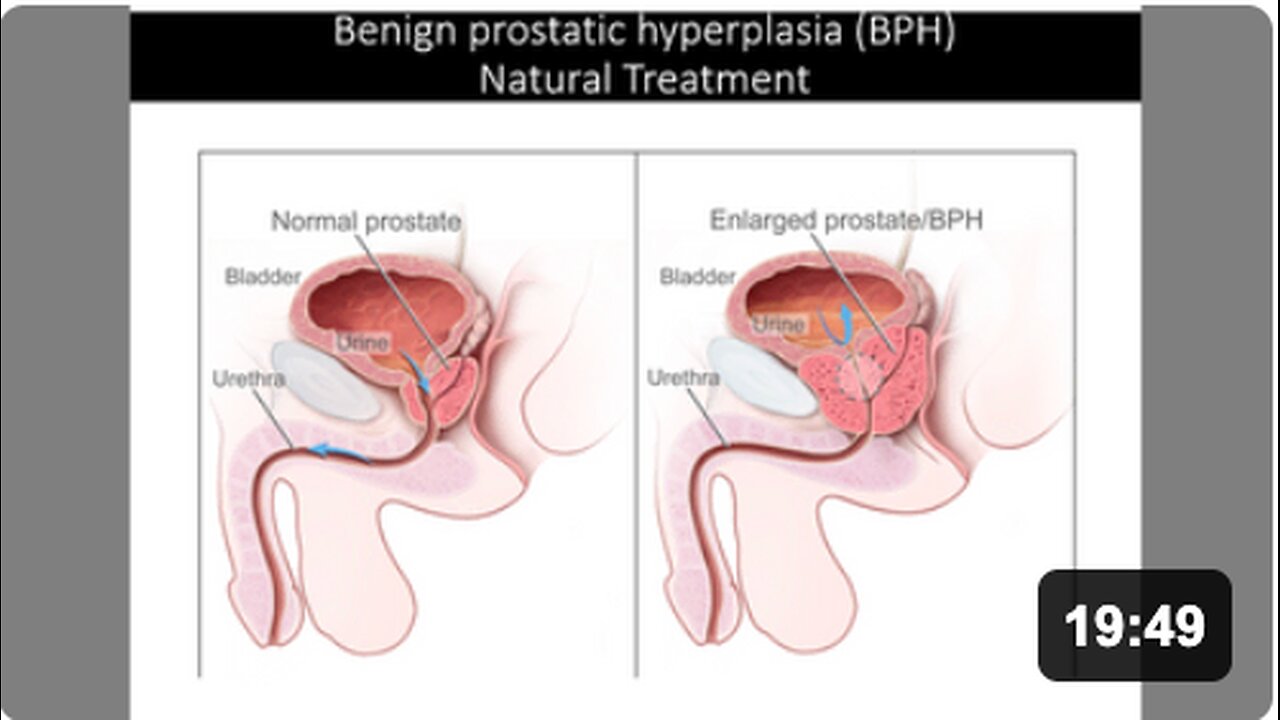 Benign Prostatic Hyperplasia - Natural Treatment