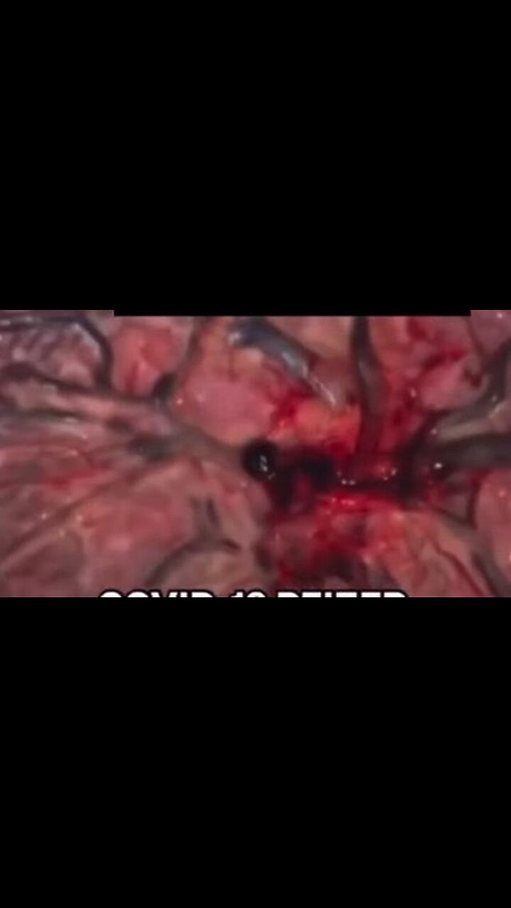 Double Vaccinated Placenta compared to Non-Vaccinated Placenta