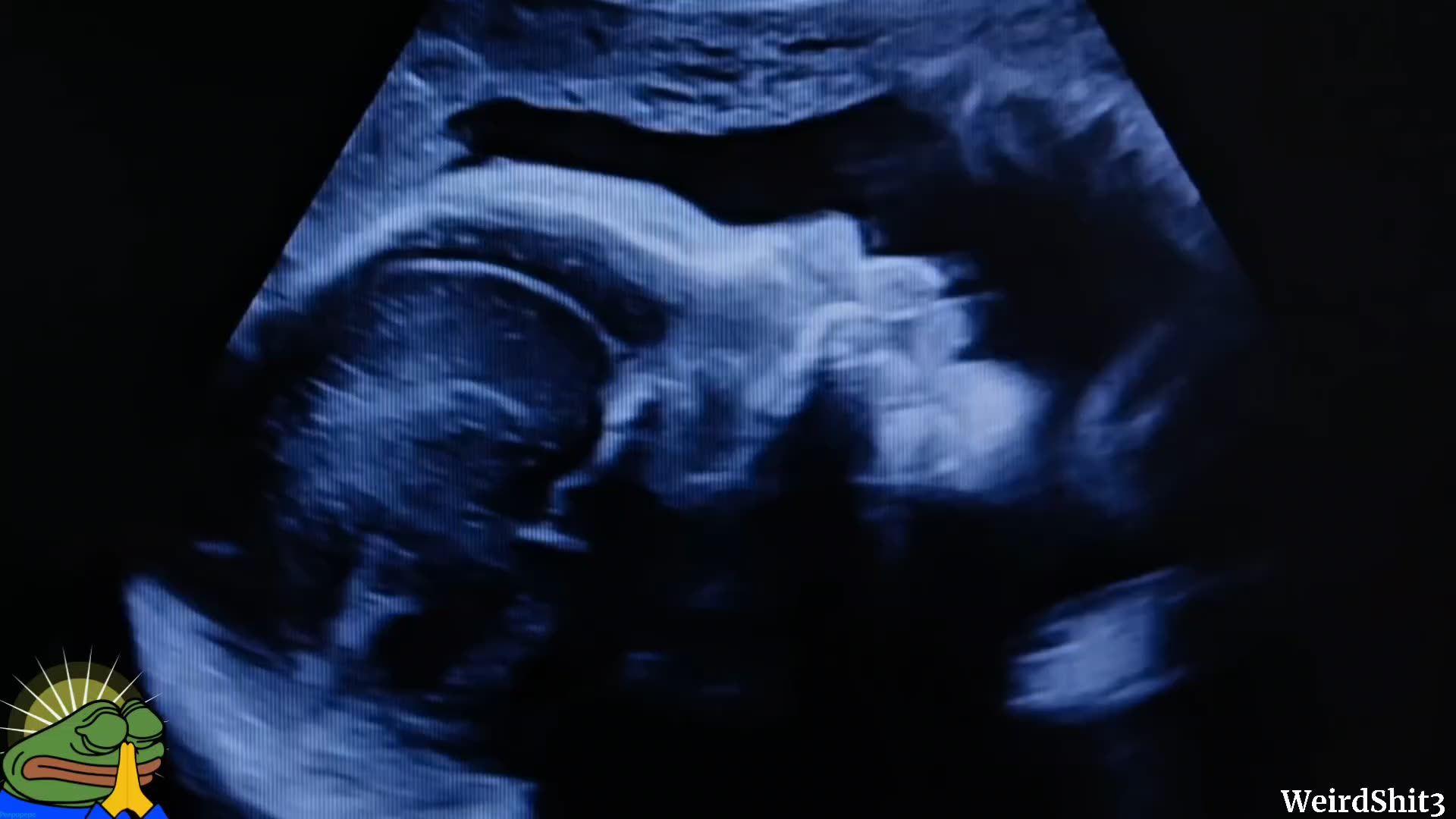 Hand Of God Shows Up On Womans Ultrasound?