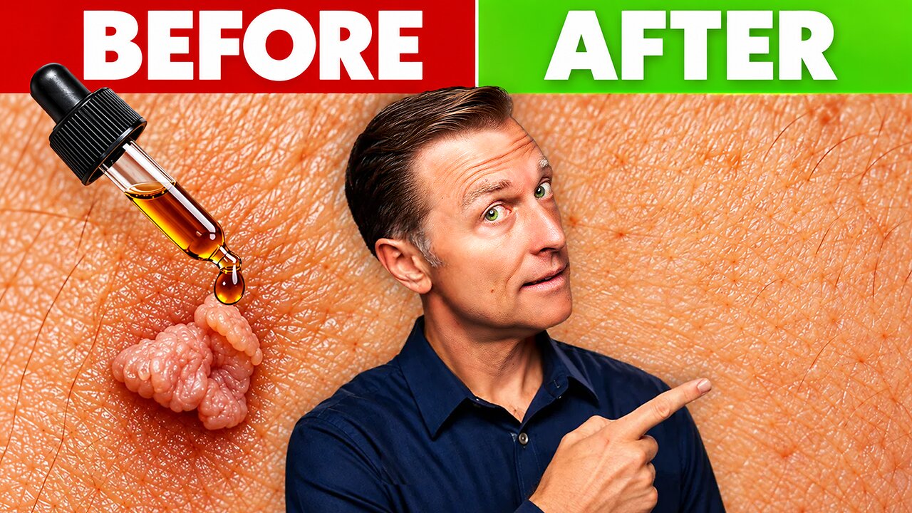 How to Get Rid of Skin Tags (&amp; Stop Them For Good) thumbnail