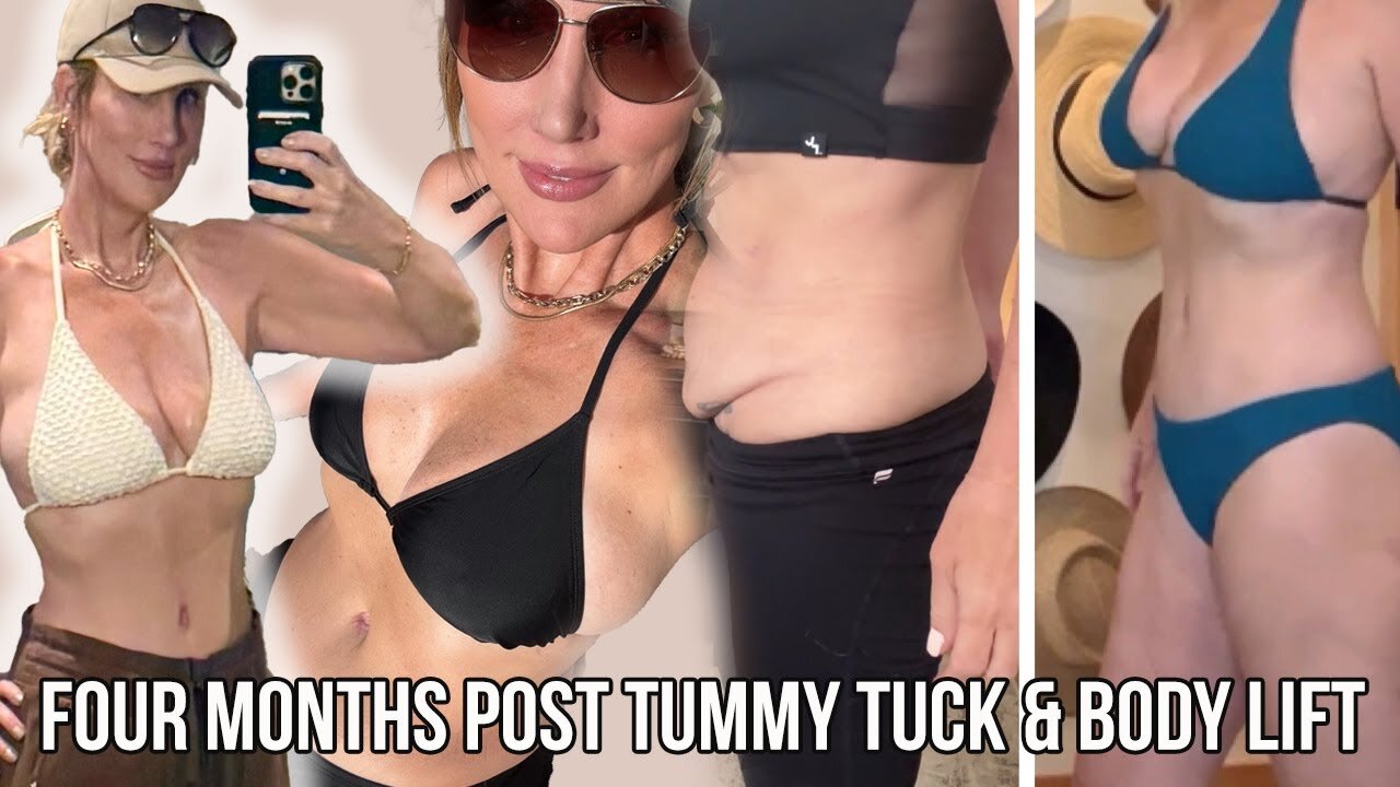Its Been 4 Months - Tummy Tuck & Body Lift Update