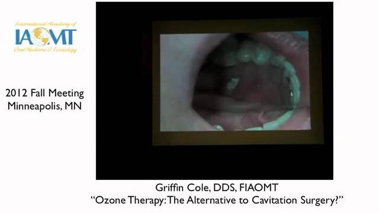 Dr Griffin Cole Ozone Therapy: An Alternative to Cavitation Surgery? IAOMT 2012 Minneapolis