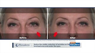 Plexaderm - March 3, 2022