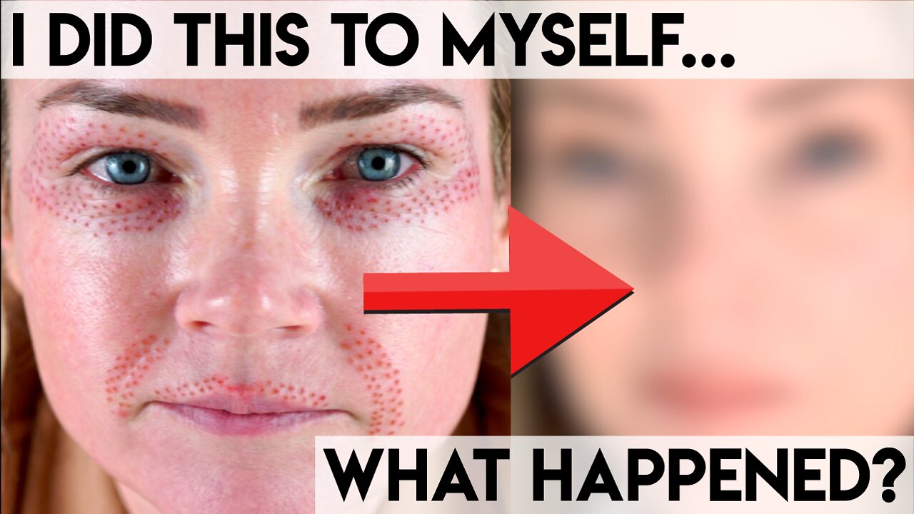 Plasma FibroBlast Experience video