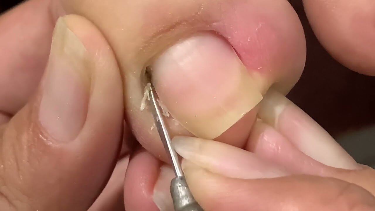 PROFESSIONAL SKIN PICKING AND FEET TIGHTENING WITH A NAIL WORKER