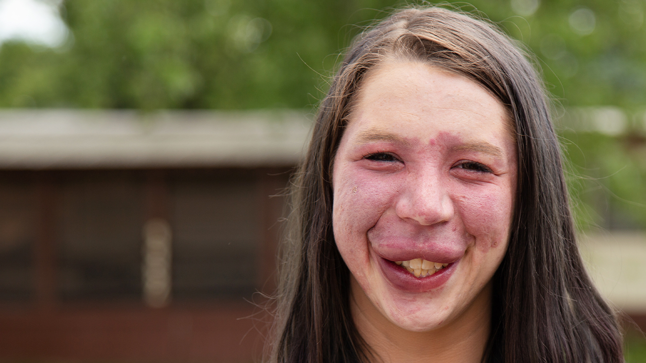 I Wont Cover My Birthmark For Bullies Anymore