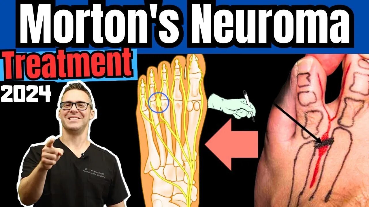 CURE Mortons Neuroma, Metatarsalgia & Ball of the Foot Pain FAST!