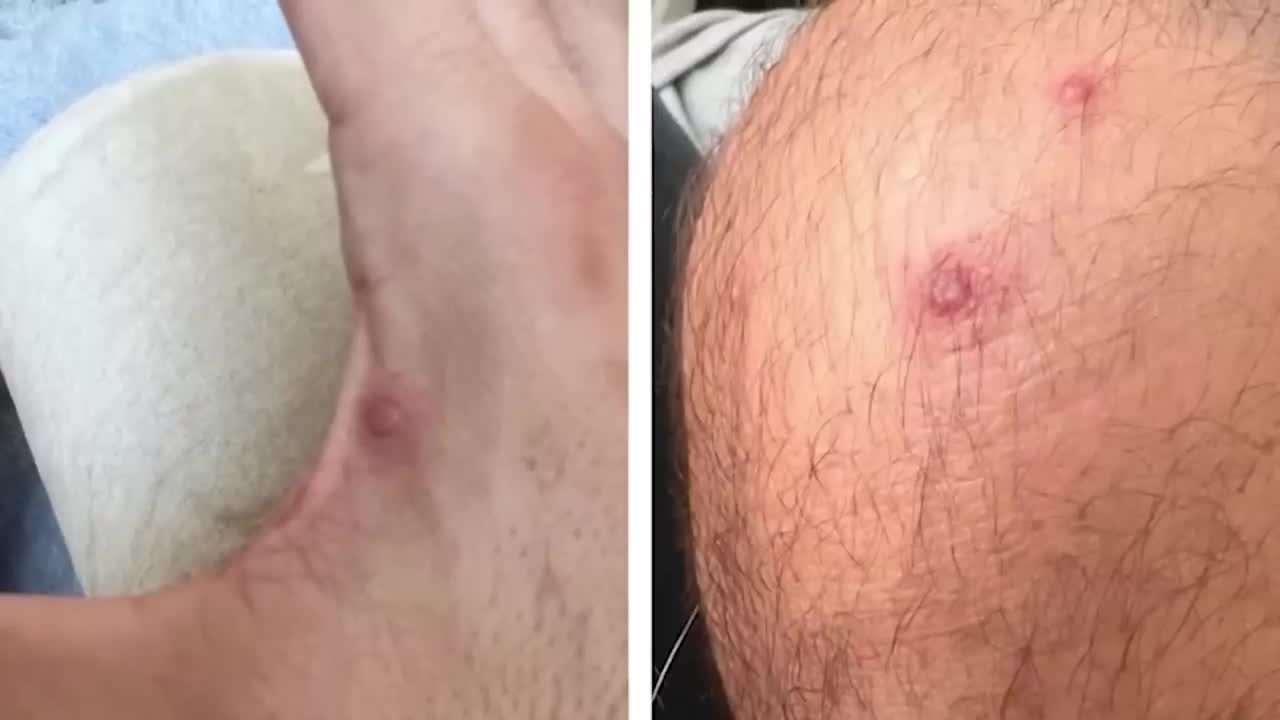 It hurts to exist | Houston man describes battle with monkeypox