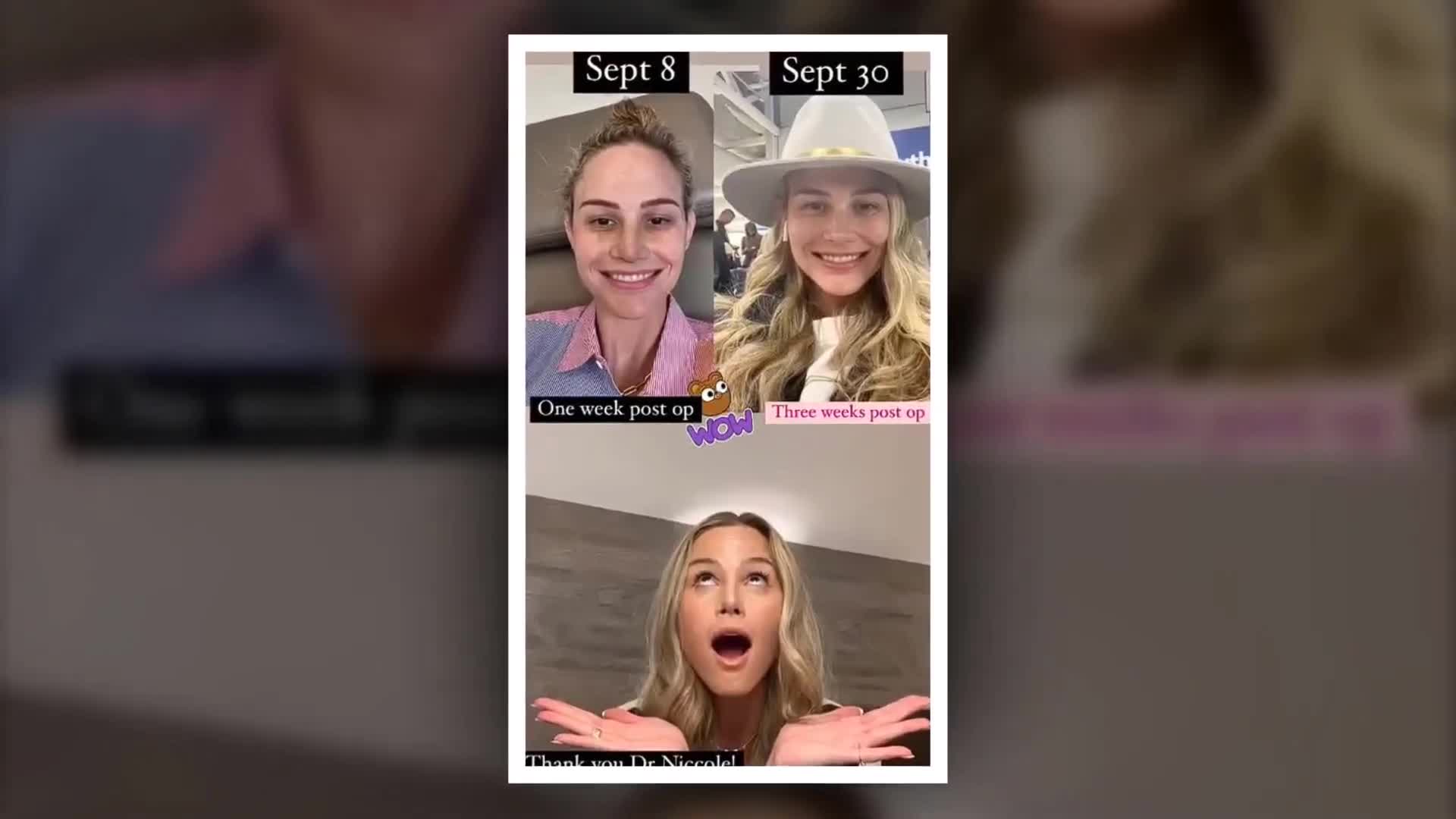 Meghan King Finally Shares Results of Her Plastic Surgery! Nose and Breast#meghan #surgery