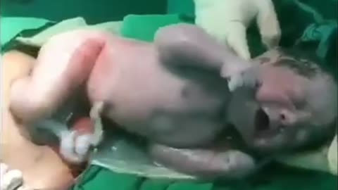 HUGE BABY BORN under CAESAREAN SECTION.